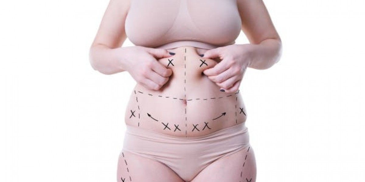 Abdominoplasty and Tummy Tuck: Understanding Your Options