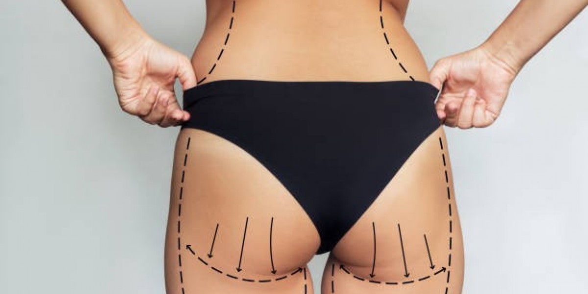 Choosing Between Butt Fillers and Fat Transfer