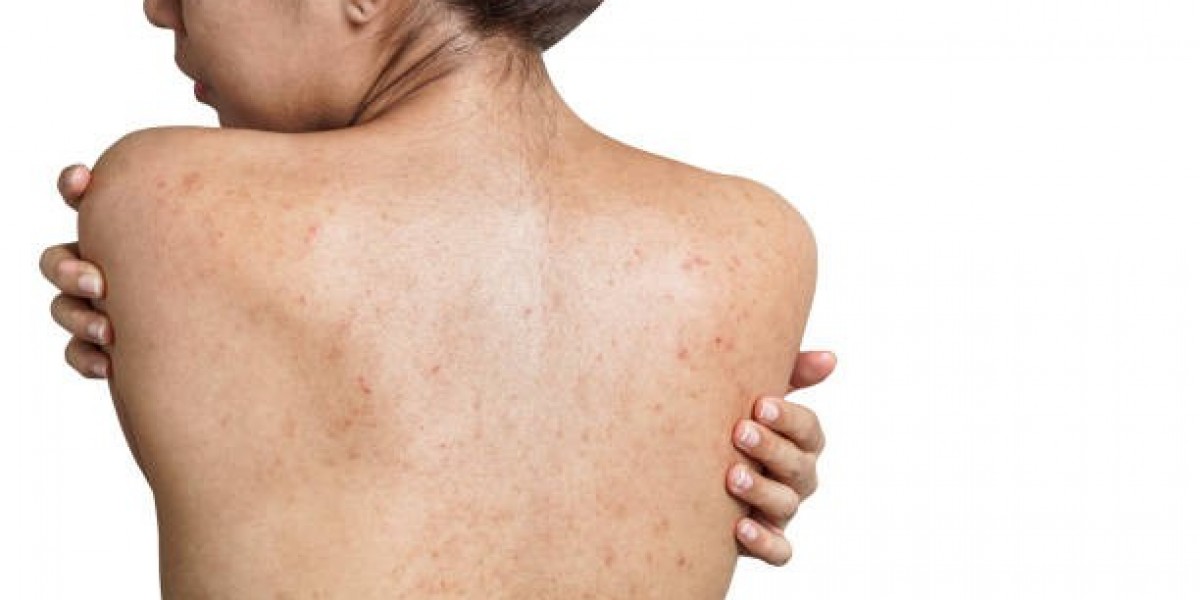 How to Keep Back Acne from Returning After Treatment