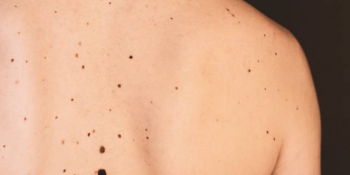 Mole Removal Choices for Safe and Healthy Skin Care