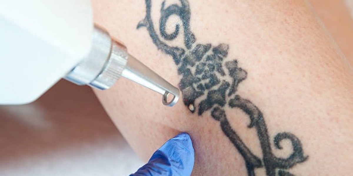 How Much Does Tattoo Removal Cost in Riyadh?