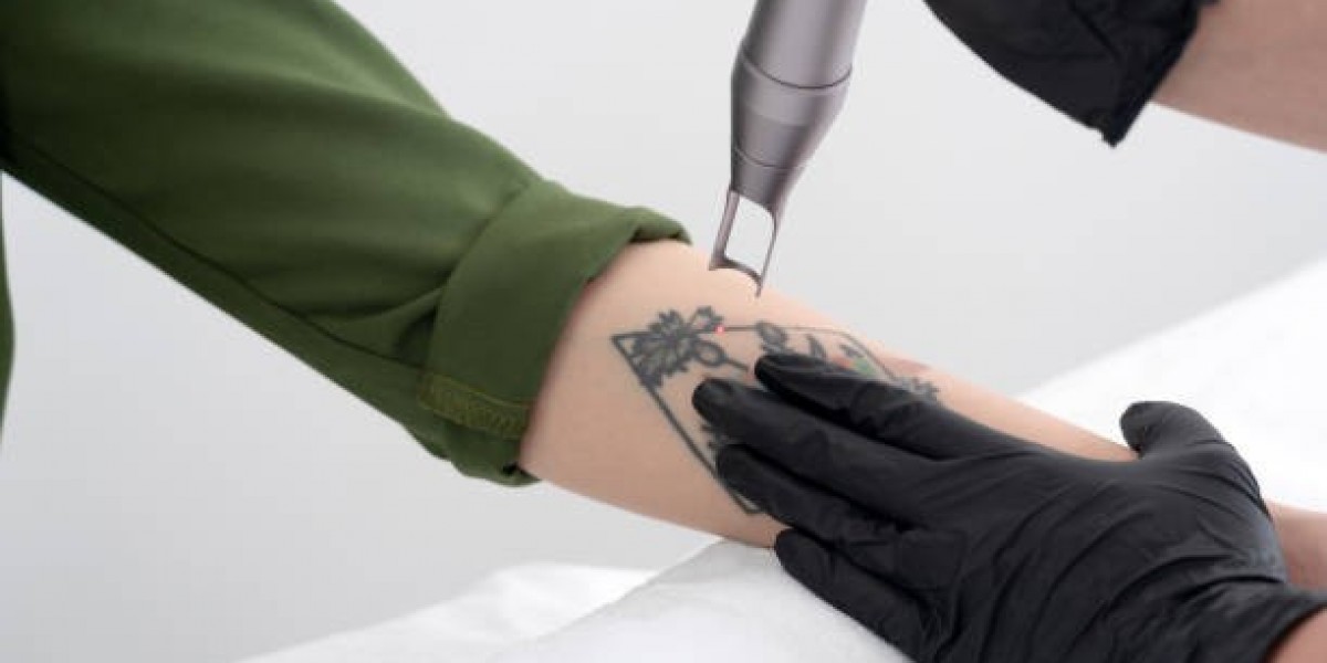Laser Tattoo Removal in Riyadh: A Guide to Modern Tattoo Removal